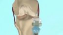 Introduction to the OrthoGlide Medial Knee Implant System